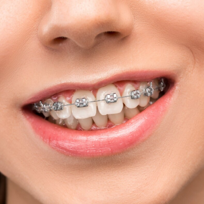 brackets metalicos